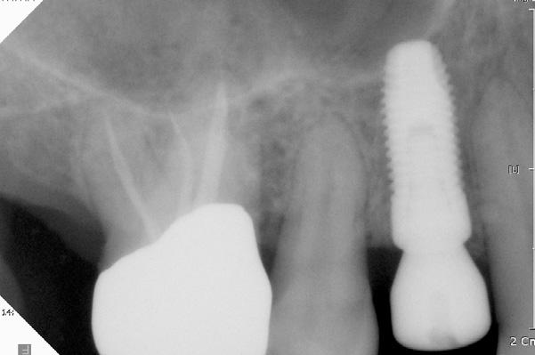 regeneration on a single tooth with