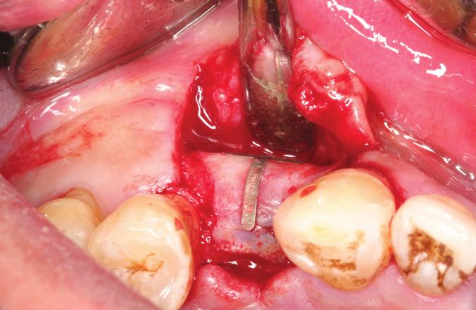 수술 부위가 수평적 그리고 수직적으로 인접치아 및 치조 협측 부위는 골과 유사한 재생 조직을 보였다(Fig.