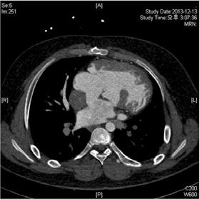 the great arteries, double-inlet left ventricle, large ventricular