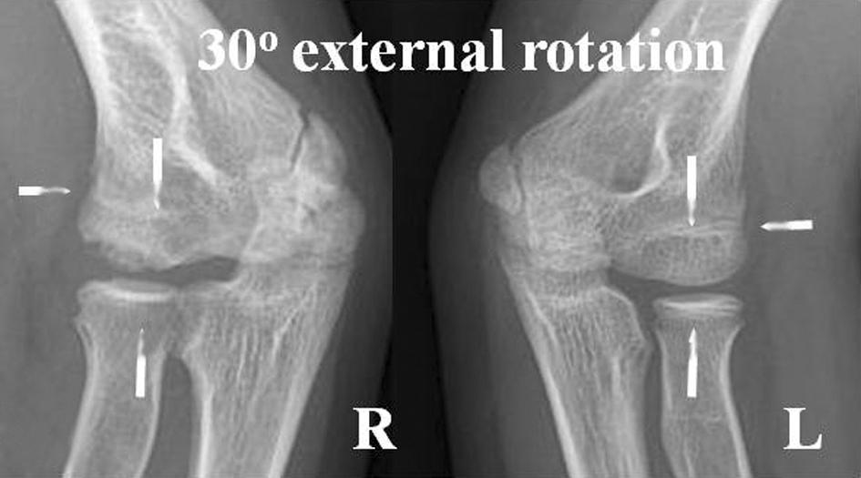 JH Ku, et al. Lateral Compartment Physeal Closure of the Elbow in Osteochondritis Dissecans of the Adolescent Baseball Players Table 2.