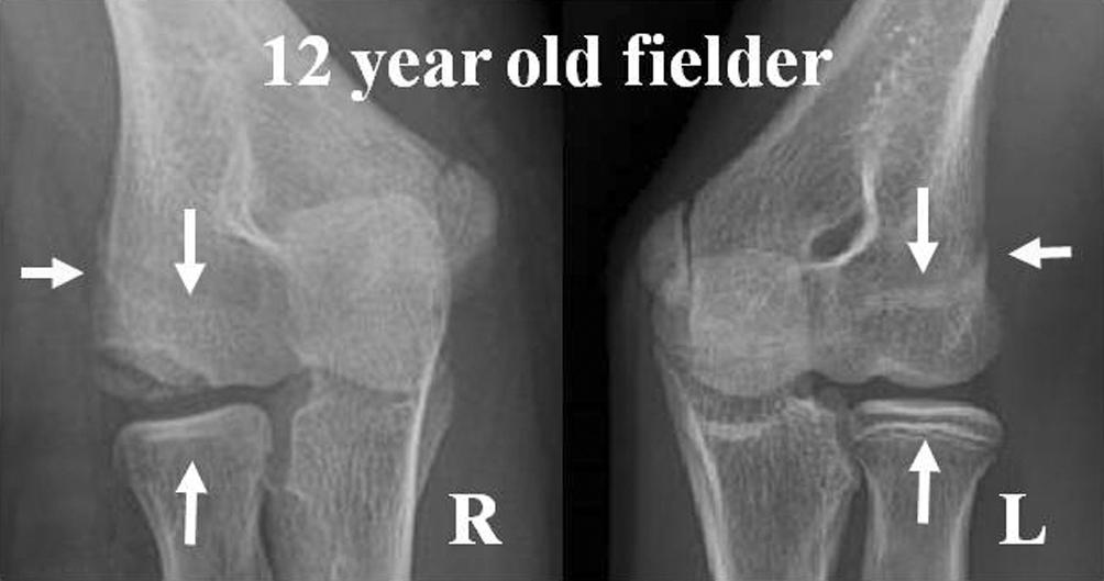 JH Ku, et al. Lateral Compartment Physeal Closure of the Elbow in Osteochondritis Dissecans of the Adolescent Baseball Players Fig. 3.