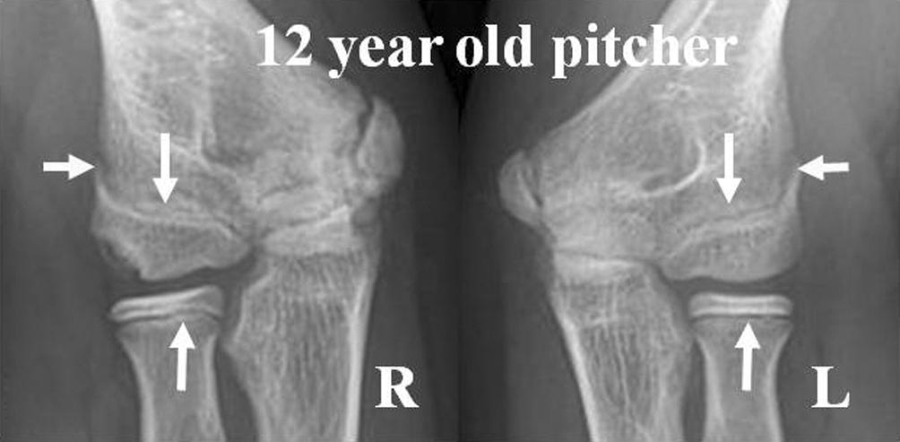 (A) Twelve-year-old pitcher with localized lateral type showed same status of lateral compartment physeal closure in both elbow.
