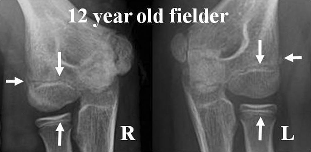 (C) Twelve-year-old pitcher with large fragmented central type showed earlier lateral compartment physeal closure than nondominant elbow.