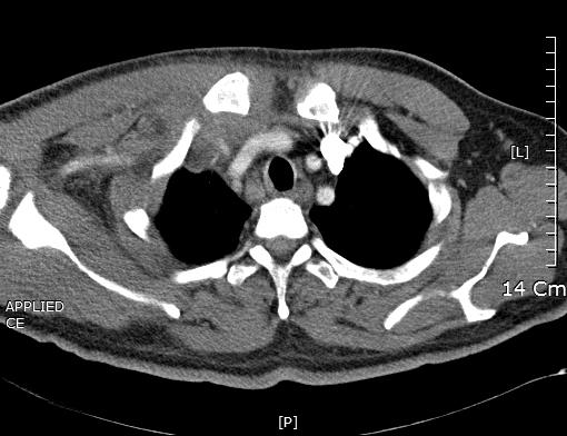대흉외지 2009;42:220-225 Fig. 1. Preoperative chest CT. Computed tomographic image (bone windows) of a patient with right sternoclavicular joint infection.