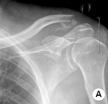 원위쇄골골절에서수술적치료방법에따른결과의비교 57 Fig. 2. (A) Radiograph of 57-year-old male shows Neer type II distal clavicle fracture.