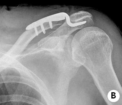 (C) Proximal screw loosening & plate migration were seen in postperative 6 months radiograph and there was subacromial impingment symptom.