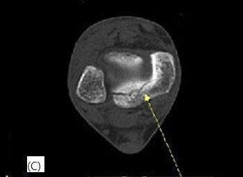 Ankle ROM상족배굴곡 20, 족저굴곡 40, 내번 5, 외번 5 이었고, ankle-hindfoot score는 63점이되었다. FFI는 0.59 로감소하였으며 EQ-5D 점수는 0.72점으로삶의질이개선되었다 (Table II, III). 3.