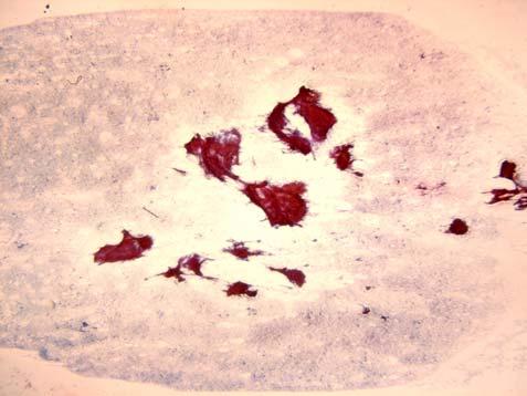 (Diff-Quick) (B) Follicle center fragments composed of small lymphocytes, TBM, centrocytes, centroblasts, and FDC are observed in large numbers.