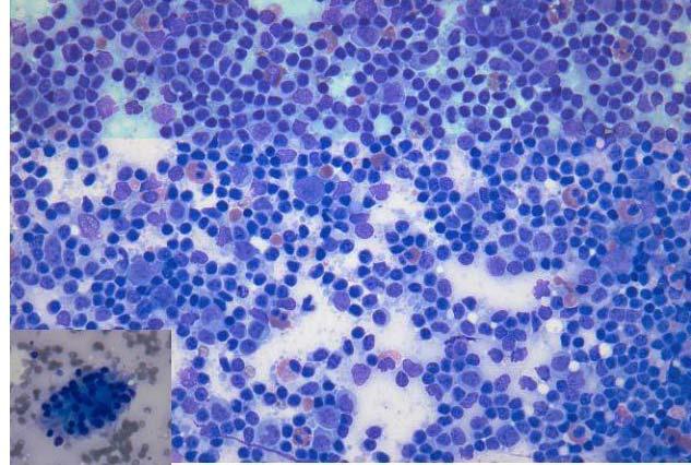 한은미외 : 양성림프절증식의감별진단 103 Fig. 2. Kimura disease. Numerous eosinophils are observed in the background of RLH pattern. Inset: Warthin-Finkleday giant cell. (Diff-Quick) Fig. 3. Infectious mononucleosis.