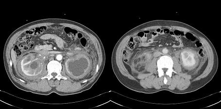 - 대한내과학회지 : 제 73 권제 2 호통권제 564 호 2007 - A B C Figure 3. (A) Pericardial thickening and bilateral pleural effusion are visible. Some patches of lung lesion are also seen.