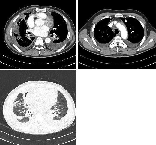 the aorto-pulmonary window. (C) Centri-nodular infiltration is also seen with both interlobular septal fissural thickenings. Figure 4.