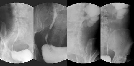 - 황현석외 6 인 : 만성신부전으로발현된 Erdheim-Chester disease 1 예 - Figure 5.