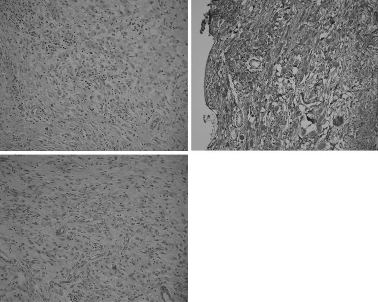 (A) ( 200): There is a diffuse lipid-laden macrophage infiltration admixed with some lymphocytes, plasma cells and a few eosinophils, along