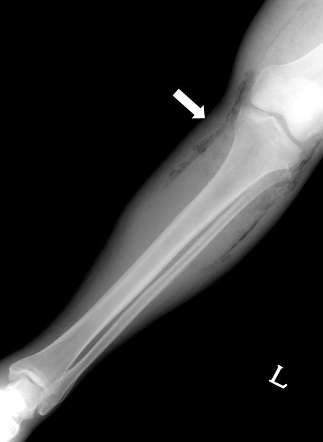 (arrow) lying on the fascia. Fig. 3.