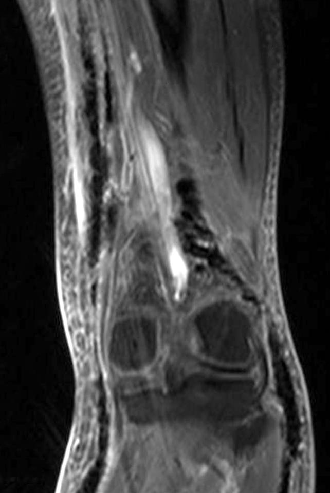 gas along the posteromedial aspect of the thigh. 견이 없었던 경우가 11예, 근막을 따라 가스 형성이 관찰 (Table 2).