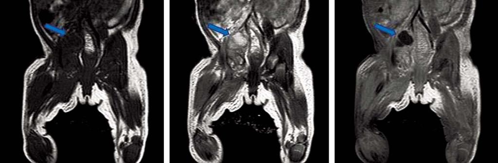 abscess pocket in adductor muscle and myositis involving adductor muscle and obturator muscle. A B C Fig. 3. 22-day-old girl with abscess in psoas muscle.