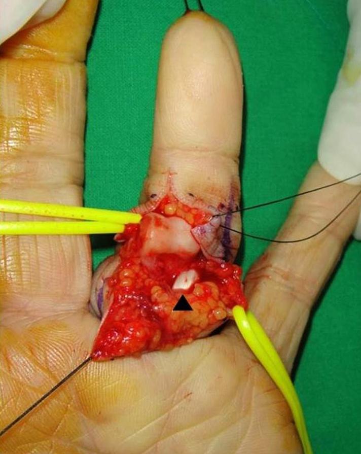 (A) The head of the proximal phalanx protruded through the palmar open wound.