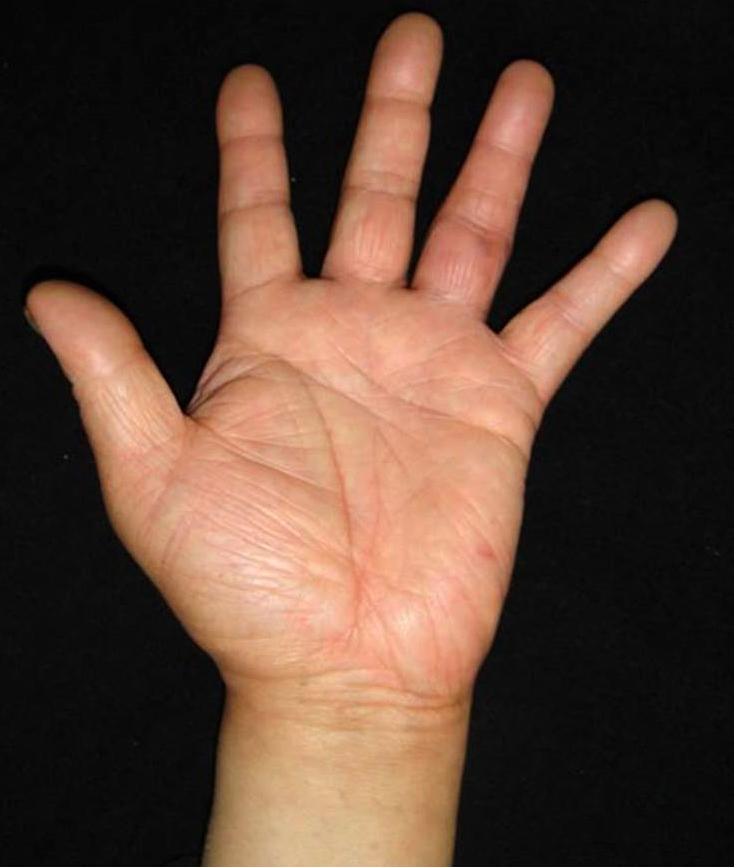 68 Youn-Tae Roh, et al. Fig. 5. At six months after the operation, there was mild swelling at the proximal interphalangeal joint. However, the patient regained a nearly normal range of motion.