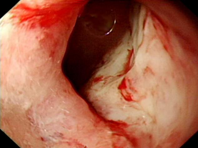 Figure 1. Endoscopic findings. (A) It shows an orifice on the greater curvature side of the high body with small amount of blood clot and mucosal thickening.