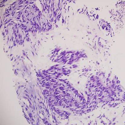 이진호외 : A Case of a Gastric Gastrointestinal Stromal Tumor with a Fistula 339 Figure 3. Microscopic findings. (A) It shows interlacing bundle of spindle cells in the myxoid stroma (H&E staining, 10).