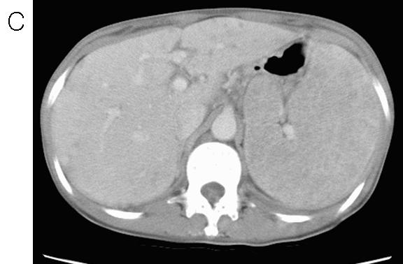 CT scan at the level of upper abdomen shows hepatosplenomegaly and disseminated tiny low density nodules in liver and spleen (C). Figure 4.