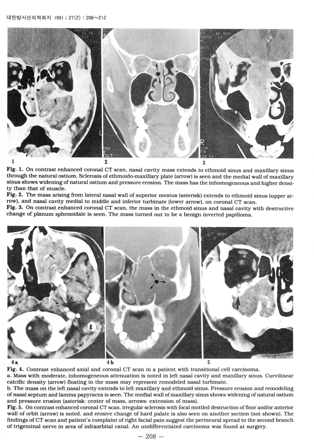 대한방사선의학회지 1991 ; 27 (2) : 206~212 1 2 3 Fig. 1. On contrast enhanced coronal CT scan, nasaj cavity mass extends to ethmoid sinus and maxillary sinus through the natural ostium.