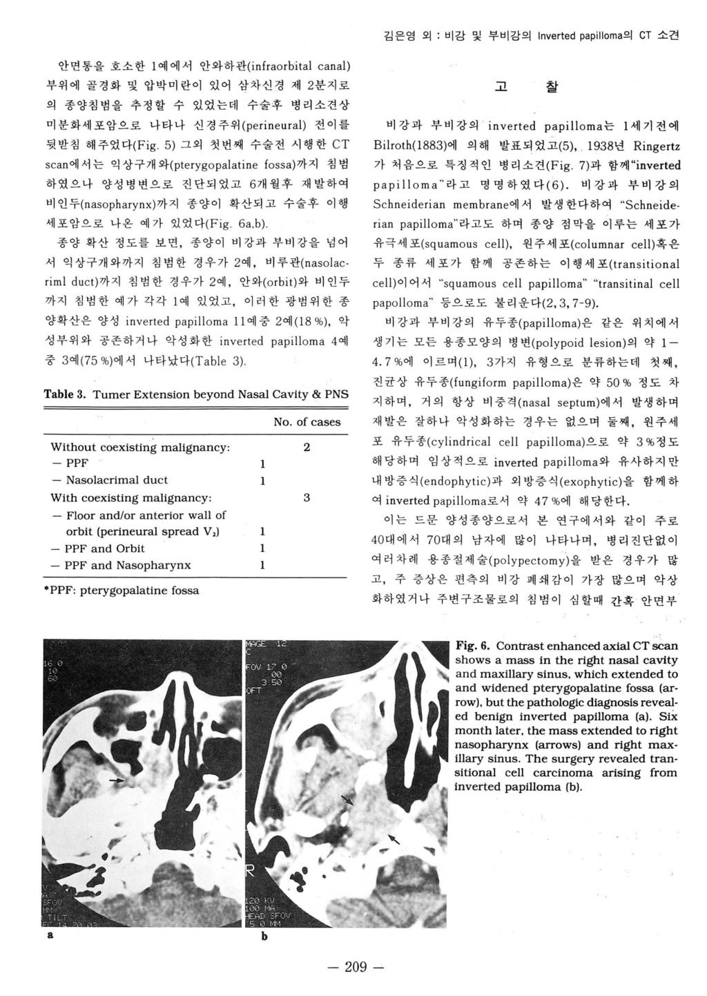 김은영외 : 비강및부비강의 Inverted papilloma 의 CT 소견 안변통을호소한 1 예에서안와하관 (infraorbital canal) 부위에골경화및압박미란이있어삼차신경제 2 분지로 의 종양침범을추정할수있었는데수술후병리소견상 미분화세포암으로나타나신경주위 (perineural) 전이를 뒷받침해주었다 (Fig.