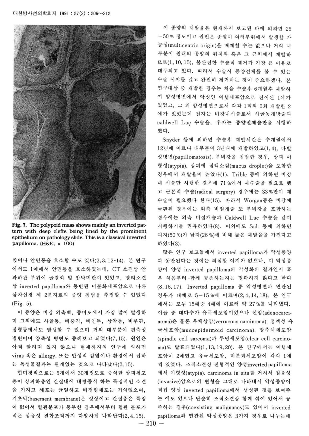 대한방사선의학회지 1991 ; 27(2) : 206~212 Fig. 7. The polypoid mass shows mainly an inverted pat. tern with deep clefts being llned by the prominent epithelium on pathology slide.