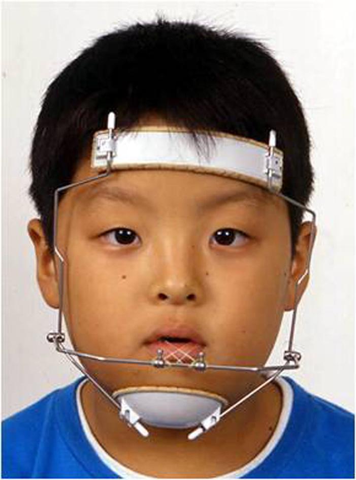 Congenital defect by cleft Post-natal repair of cleft by surgery Scar tissue occurred from surgery The most powerful and least controlled force causes collapse of the