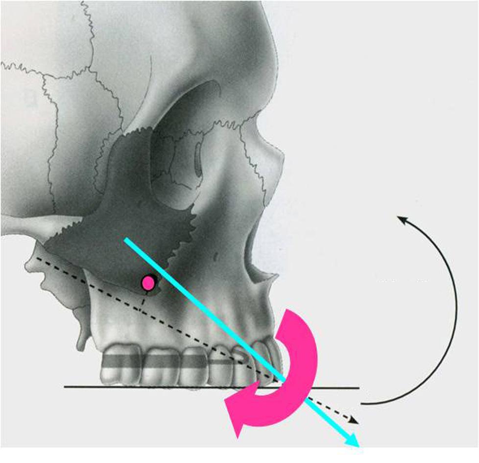 Maxilla 30 Figure 5. 상악골후방부의하방이동을최소화하기위하여상악견치전방부에서교합평면에대하여전하방 30~45 도로견인력을부여해야한다. RPE 사용목적은상악골주변의봉합부를탈구시켜상악골전방견인효과를극대화하기위함이며 (Figure 4), 7-10) 확장은 0.25mm 2 / day, 기간은 1~2 주정도이다. 4. 상악골전방견인력의크기, 방향및기간편측당 350~400g의크기로하루 14시간이상사용해야한다.