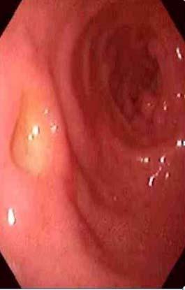 소화성궤양 (Peptic Ulcer) 소화성궤양의임상양상 : 십이지장궤양 :