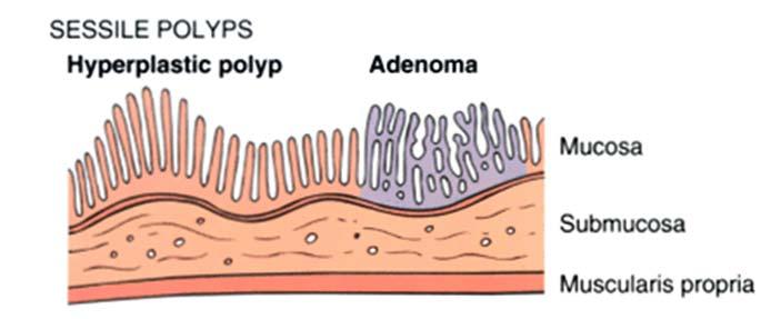 대장용종 (Intestinal Polyp) 정의 : 점막위로돌출된양성종양또는종양성병변유형 : 꽃자루형 (Pedunculated)