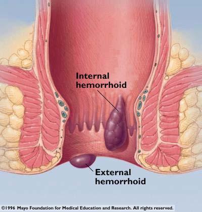 치질 (Hemorrhoids) 정의 : 직장과항문에있는정맥의이상적확장 증상 : 출혈, 대변내신선한혈액, 항문주위소양감, 직장탈출, 혈전 원인 : 변비, 항문에힘을주는경우, 복압증가, 비만, 임신.