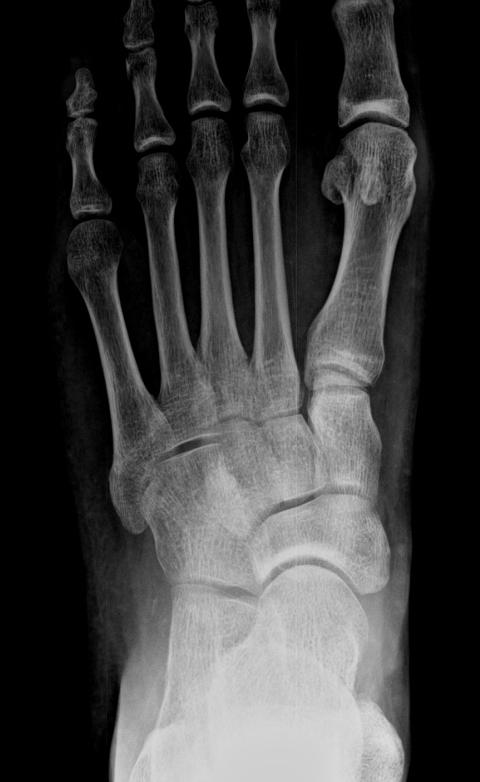 최영낙 최영락 서정호 이호승 김상우 정재중 A B Figure 2. 68-year-old man with zone I fracture of 5 th Metatarsal bone. Initial foot A-P view with comminuted fracture.