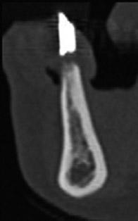The CBCT images at the mandible.