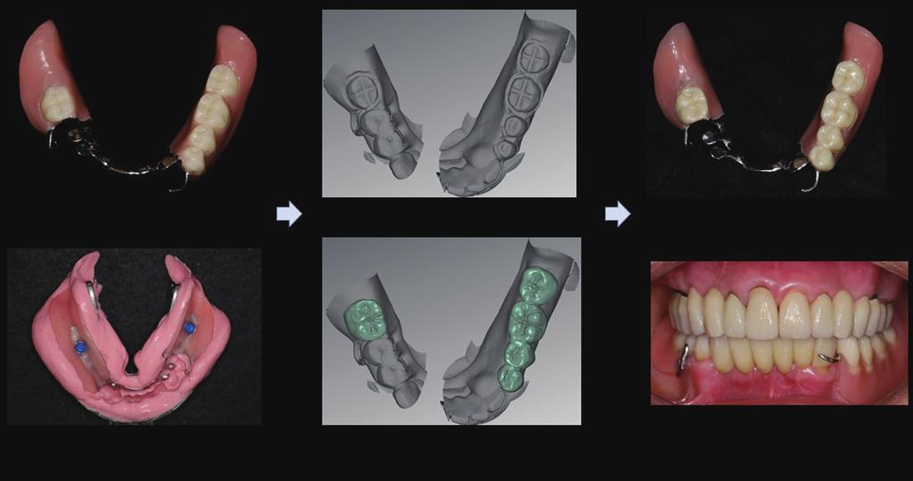 using/through double scanning method, (C) Final denture after cementation of zirconia occlusal prosthesis on the occlusal surface. Fig. 10. Post-treatment panoramic radiograph. 산에더나은결과를보인다고하였다.