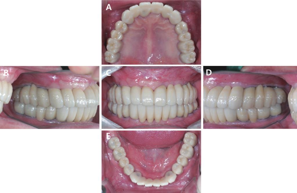 Fig. 11. Definitive prosthesis. (A) Maxillary occlusal view, (B) Right lateral view, (C) Frontal view, (D) Left lateral view, (E) Mandibular occlusal view. Fig. 12.