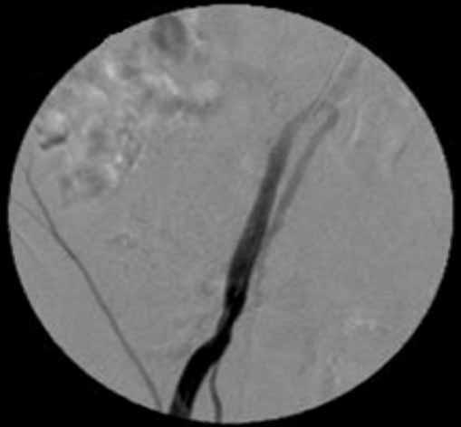 는측부순환이매우잘발달된고도협착 (severe stenosis with good collateral)