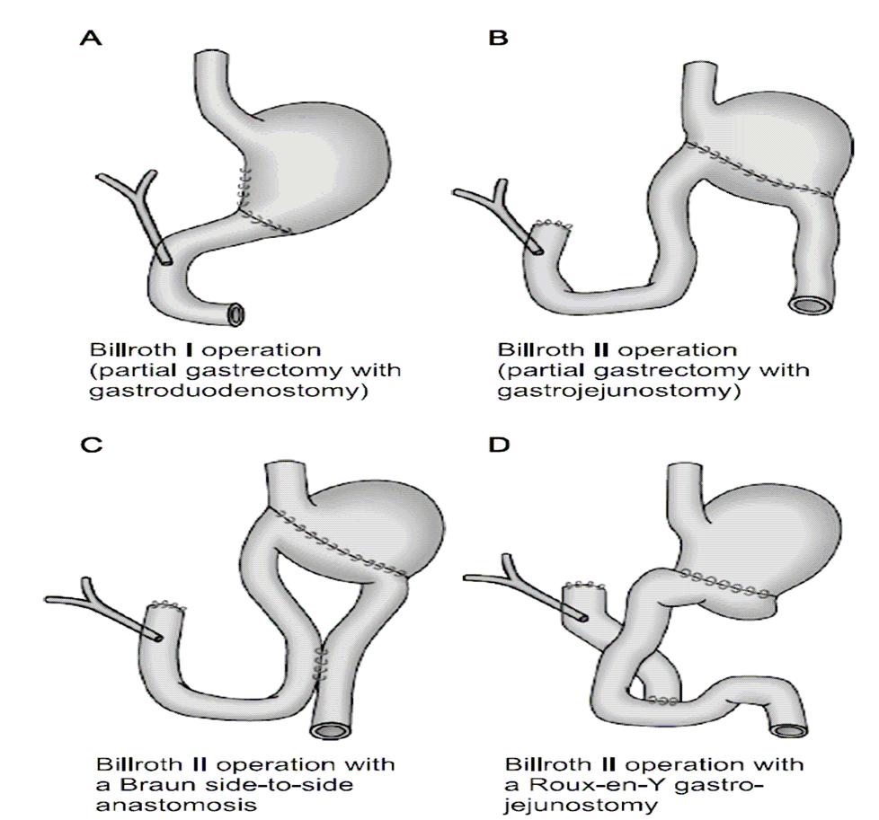 A B C D Fig. 2. The survival rate of subtotal gastrectomy vs total gastrectomy. Fig. 1. Reconstructive techniques after partial gastrectomy. 제거로인해위내로담즙의역류가흔히관찰된다.