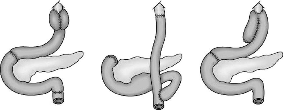 Figure 3. Reconstructive technique after total gastrectomy. loop) 으로들어가는 2개의구멍이관찰된다.