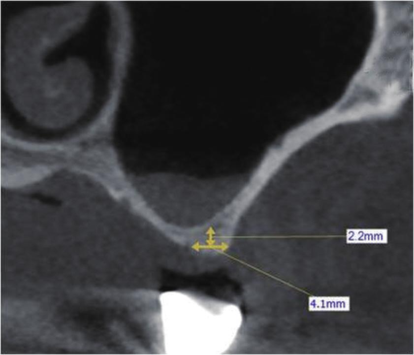 방사선상에서상악동내이식골과임플란트변연골은흡수없이안정적으로유지되며새 롭게형성된상악동하연이뚜렷히관찰된다 (Fig. 5).