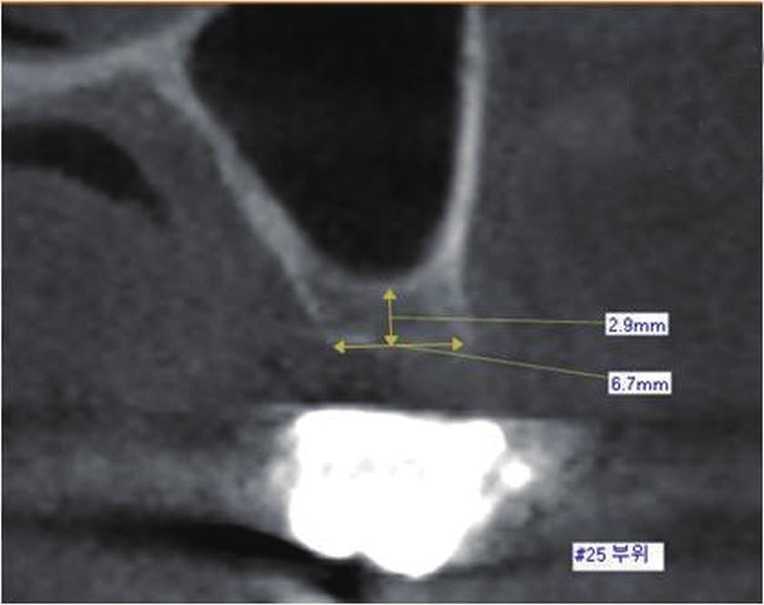 5 초기에치조정접근법은 1994년 Summers 에의해제안된골절도 (osteotome)