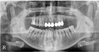 Left maxillary sinus bone graft and delayed implant placement were planned. (B) Panoramic radiograph after bone graft.