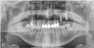 Implants were installed with nonsubmerged technique 3 months after bone graft. (D) Panoramic radiograph at 21 months after prosthetic loading.
