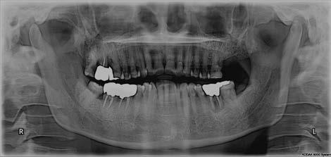 report Pilmo Koo, Dong-Mok Ryu, Yu-Jin Je, Deok-Won Lee Department of Oral and Maxillofacial Surgery, Kyung Hee University Dental Hospital at Gangdong, Kyung Hee University, Seoul, Korea Dental