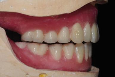 and (C) lateral view (left) of wax denture at