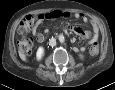 - 대한내과학회지 : 제 88 권제 3 호통권제 655 호 2015 - Figure 5. Follow up computed tomography finding (abdomen and chest).