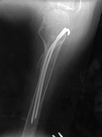274 강호정, 이대영, 성승용, 한수봉 B A C Fig. 1. (A) Humeral neck fracture was treated with Rush pins (The patient suffered from pain for 6 months after initial surgery).