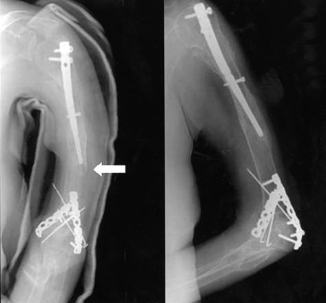 상완골근위부골절의골수정삽입술을이용한수술적치료 275 A B A B Fig. 3. (A) Periprosthetic fractue was developed after slip down because of severe osteoporosis.