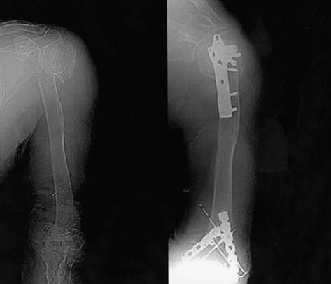 (B) Fractures ware fixed using plate and screws. (C) Fixation failure 4 weeks later. (D) Radiologic union was shown on radiographs that were taken 2 months later 결과를가지면서근위부로의핀의미끄러짐현상을피할수있다는장점을가지고있다.